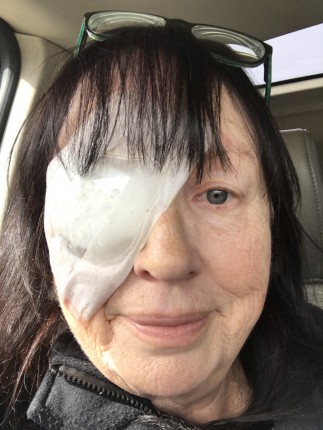 Cataract surgery still in Keto mode????????