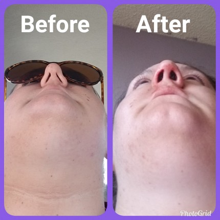 So.. i had surgery yesterday. I had a Rhinoseptoplasty done because as you can see by my before pic,