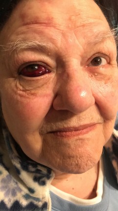 Here’s a weird picture of my grandma! She just hit her face on her wall at home. Looks pretty cool h