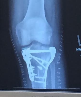 Looking for a little help from someone who has experience in this area.I need a GOOD knee brace for