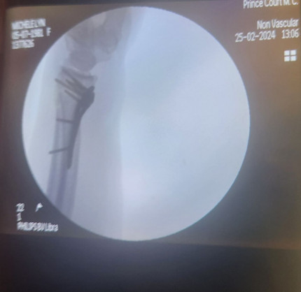 So rejoined dietbet after while recovering from an ankle break and then went too hard playing footba